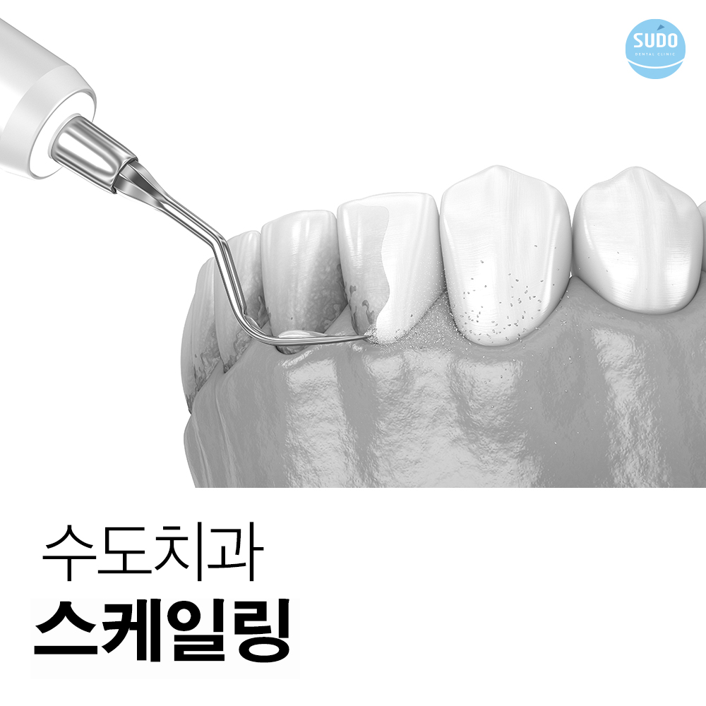 수도치과 스케일링