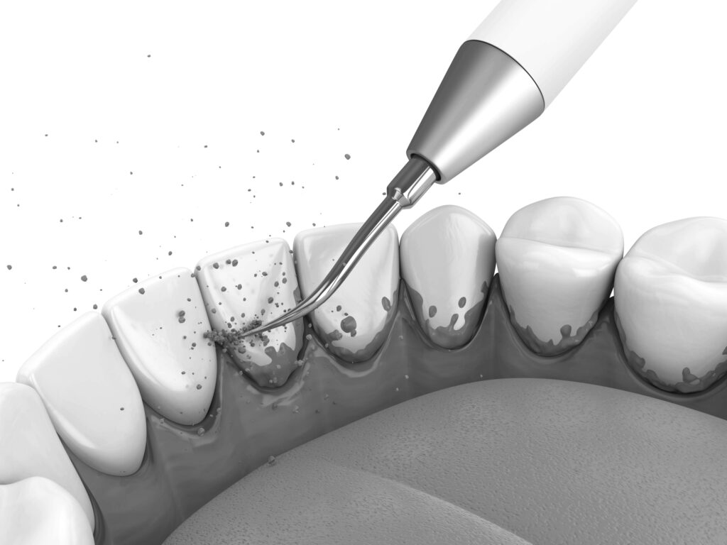 수도치과 스케일링