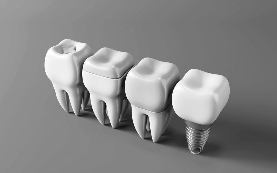 수도치과 임플란트