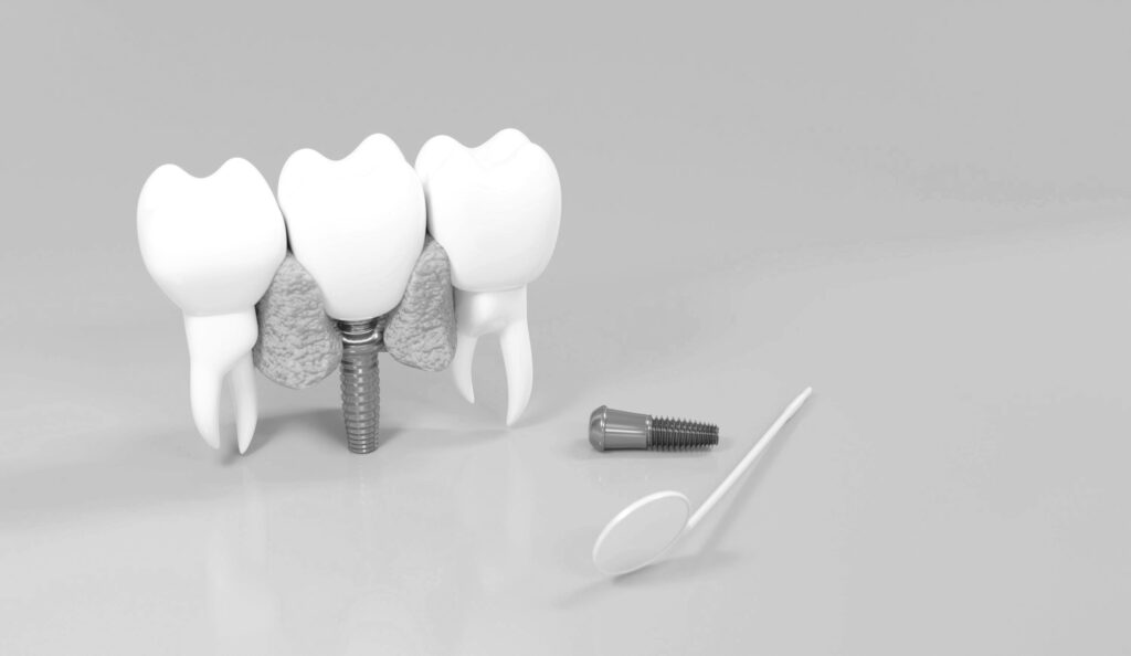 수도치과 임플란트