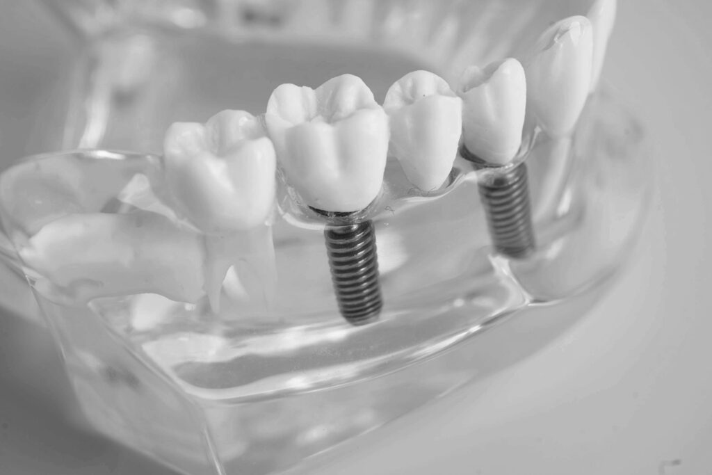 수도치과 임플란트