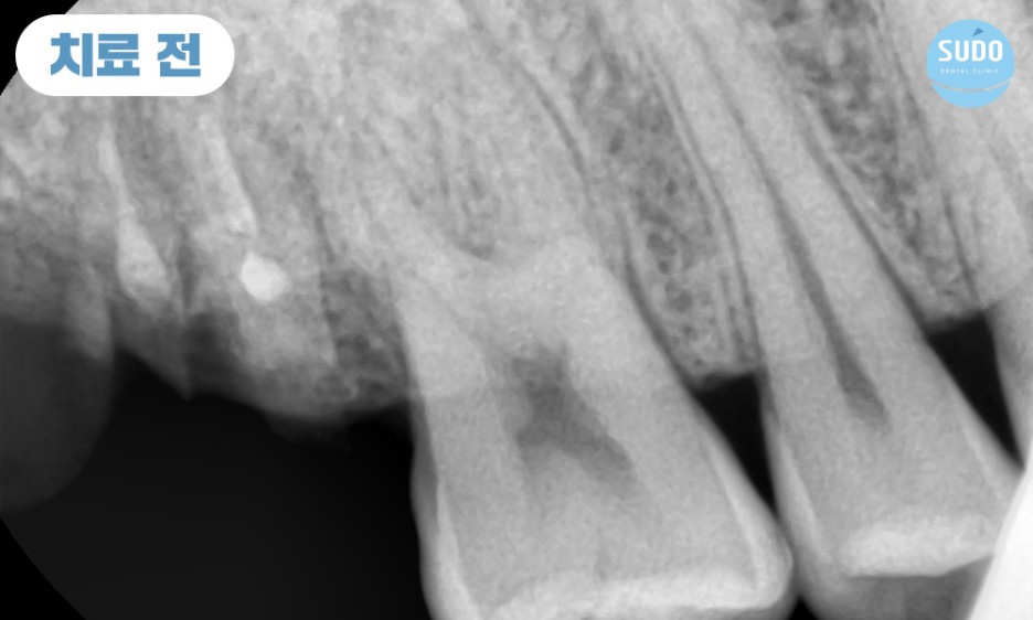 수도치과 임플란트