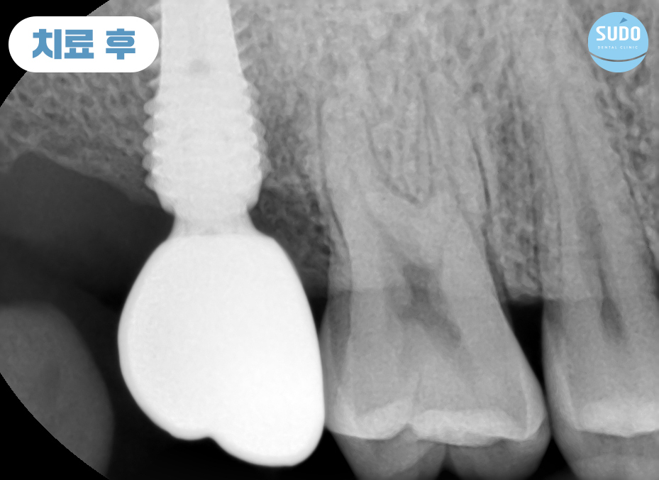 수도치과 임플란트
