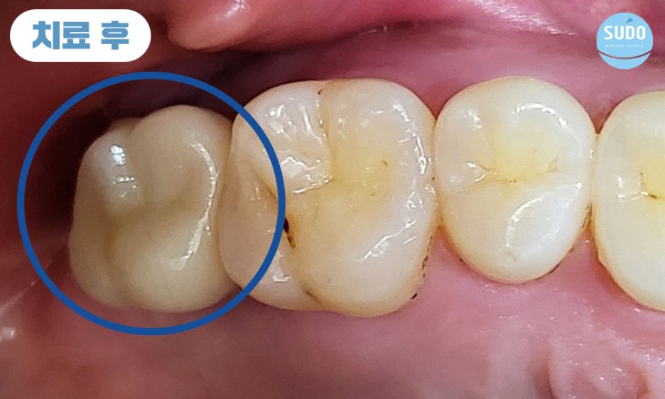 수도치과 임플란트