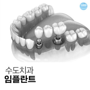 수도치과 임플란트