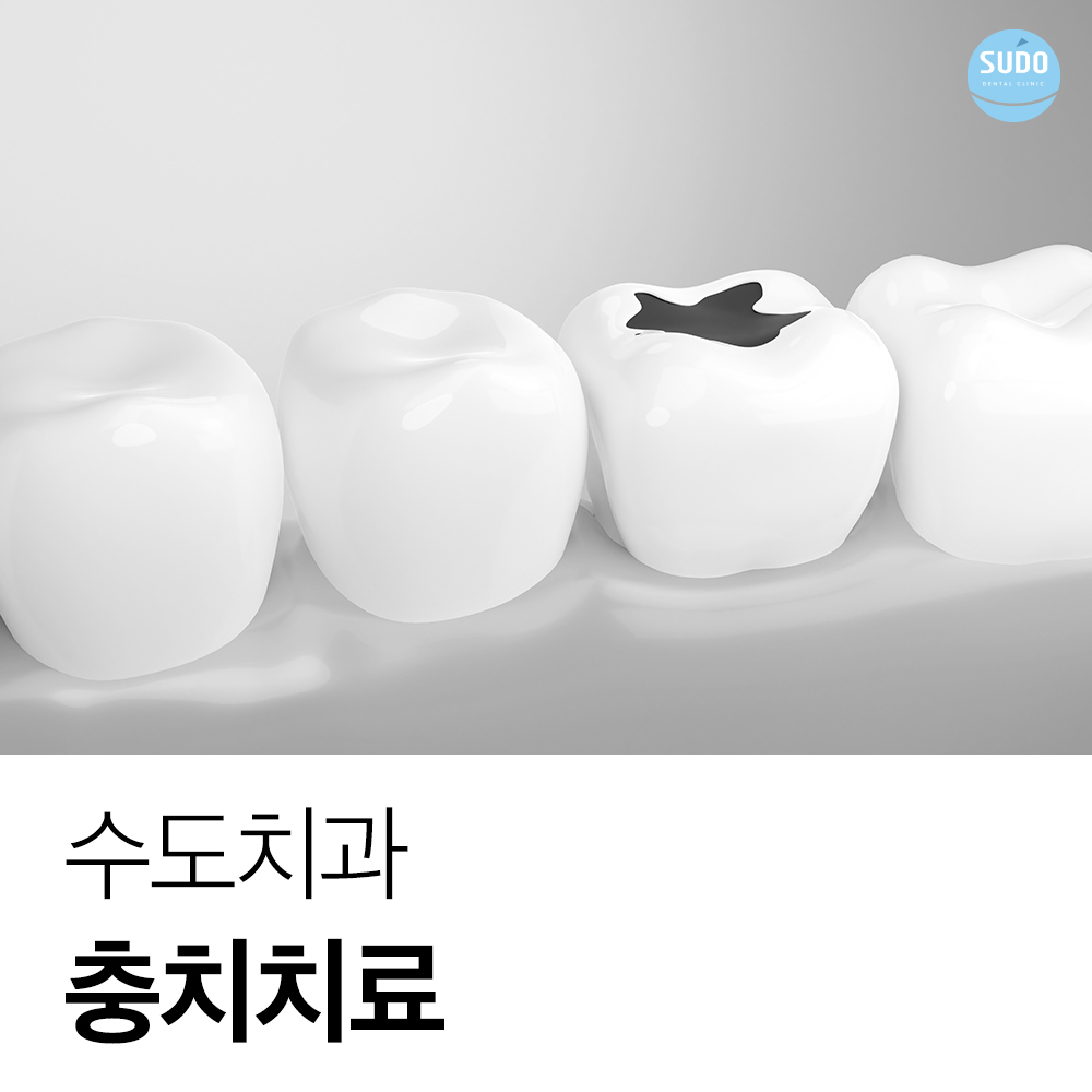 수도치과 충치치료