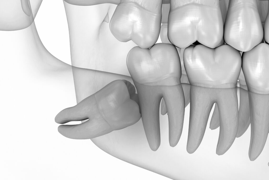 수도치과 사랑니발치