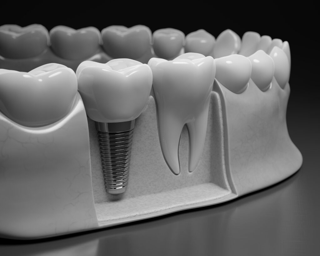 수도치과 임플란트