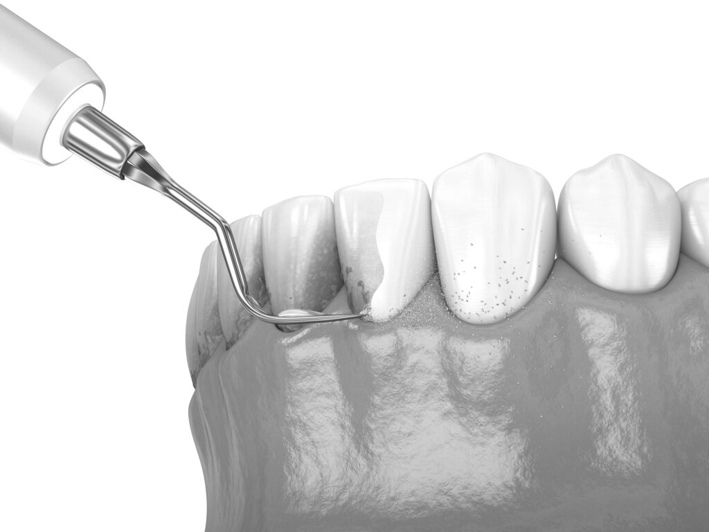 수도치과 스케일링