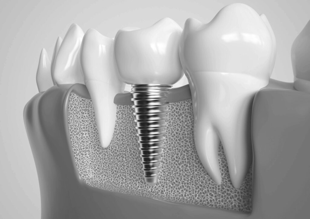 수도치과 임플란트