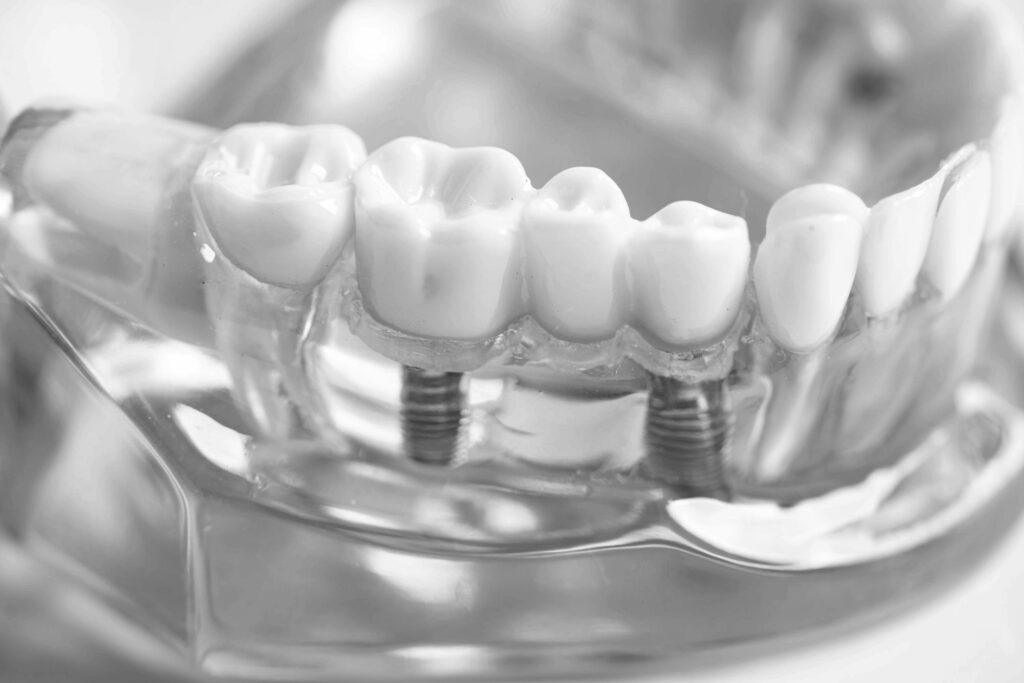 수도치과 임플란트