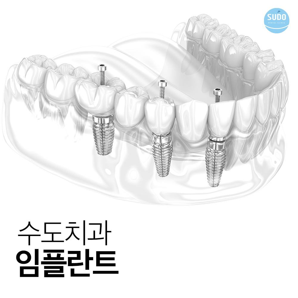수도치과 임플란트