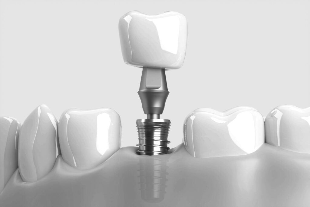 수도치과 임플란트