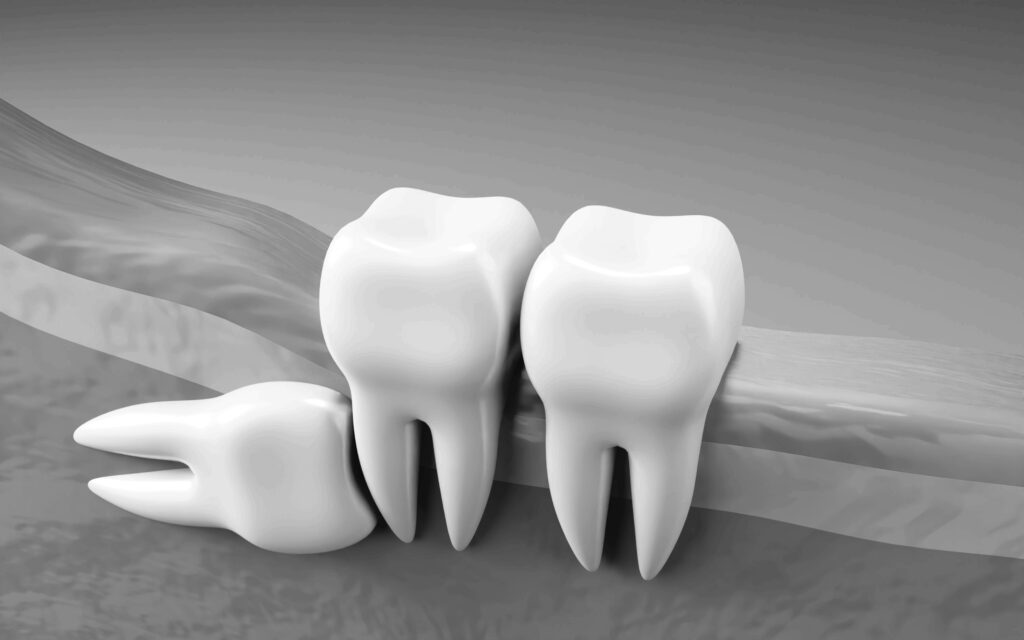 수도치과 사랑니발치