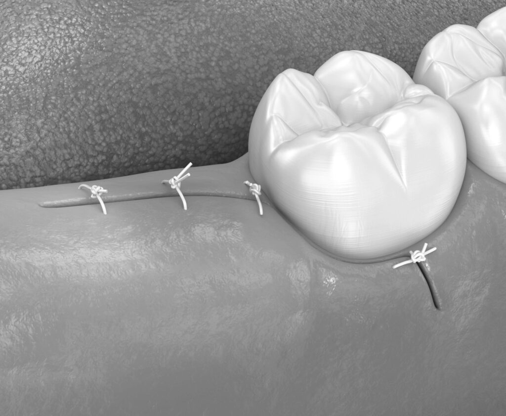 수도치과 사랑니발치