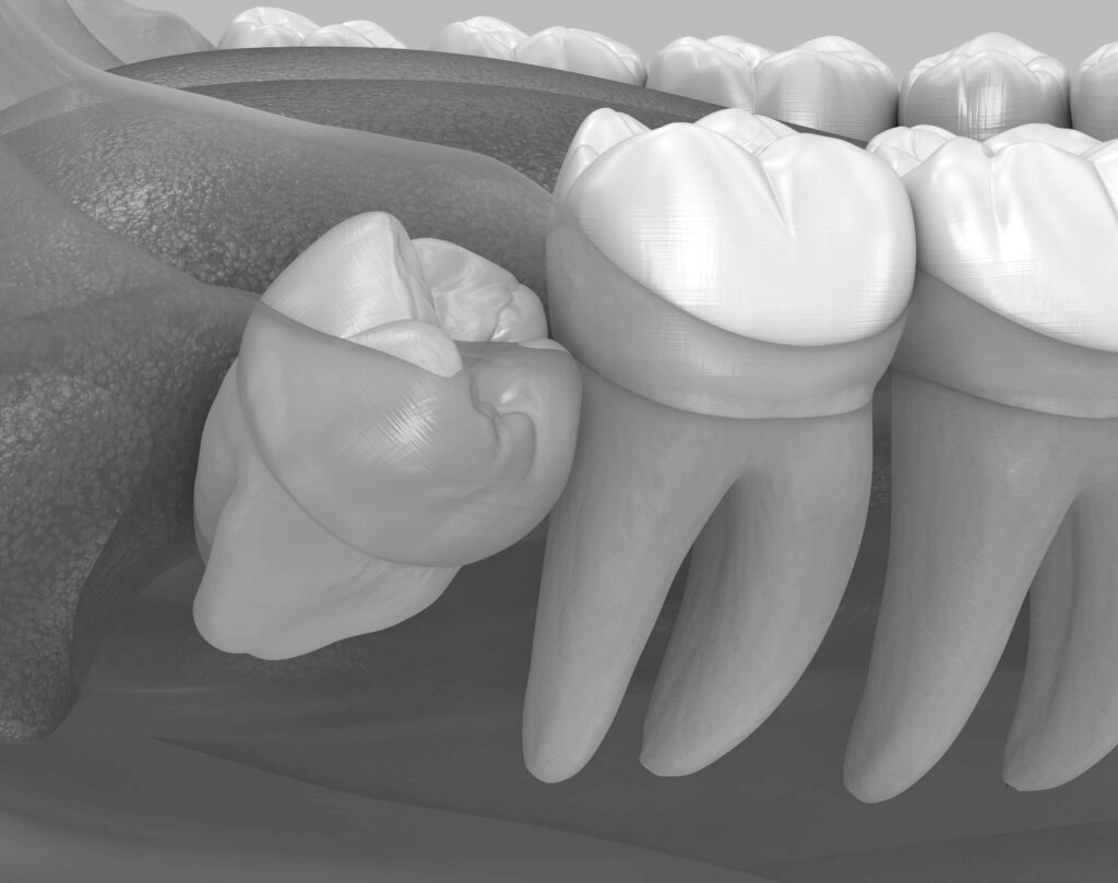 수도치과 사랑니발치