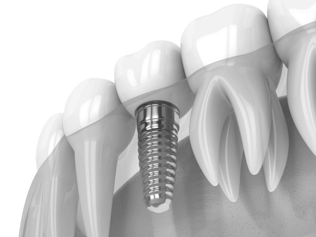 수도치과 임플란트