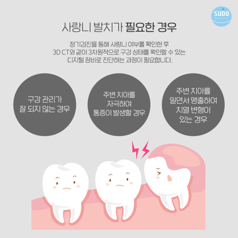 수도치과 사랑니발치 후 충치치료