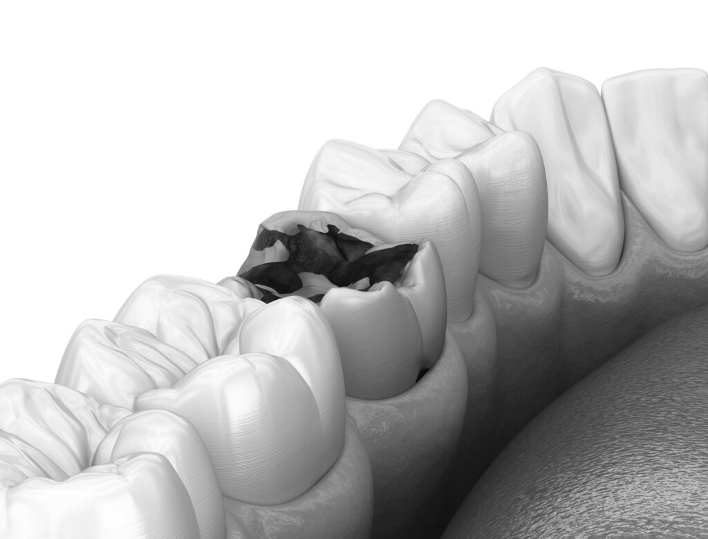 수도치과 충치치료