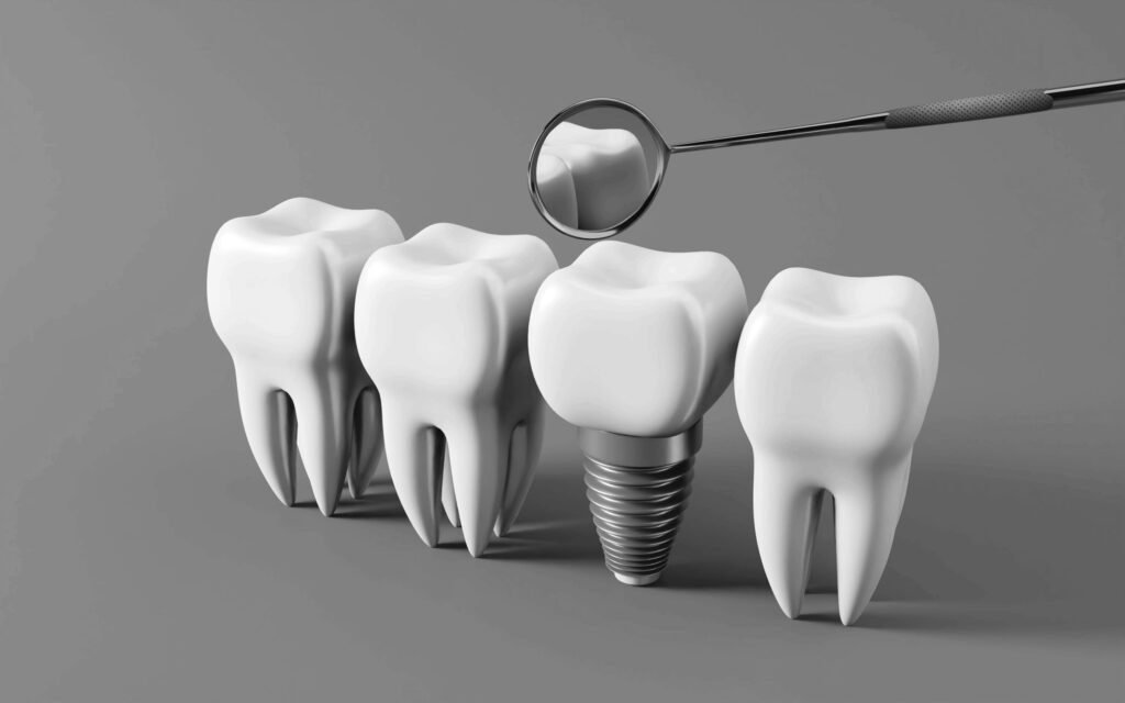 수도치과 임플란트