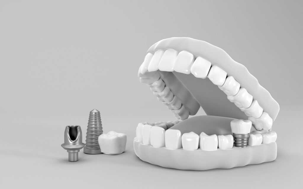 수도치과 임플란트