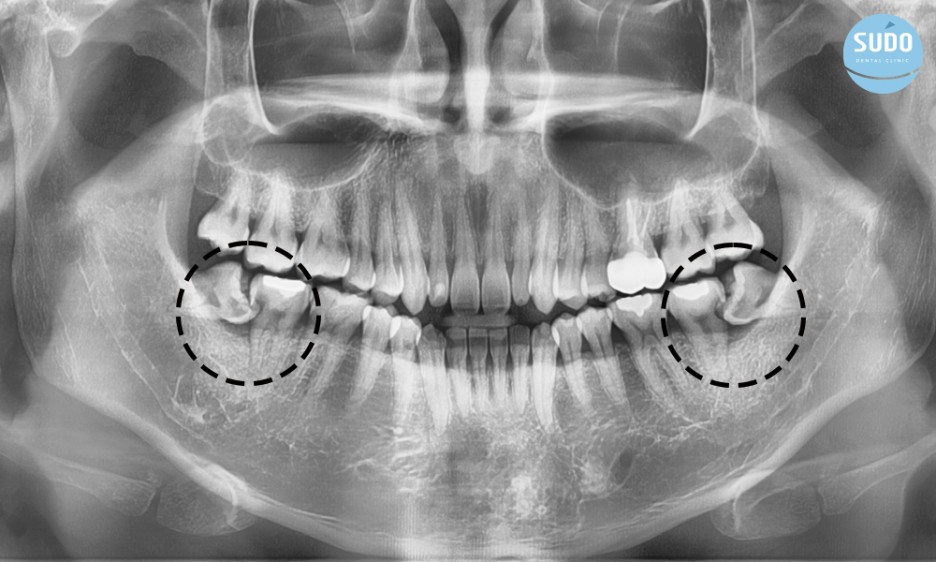 수도치과 사랑니발치 후 충치치료