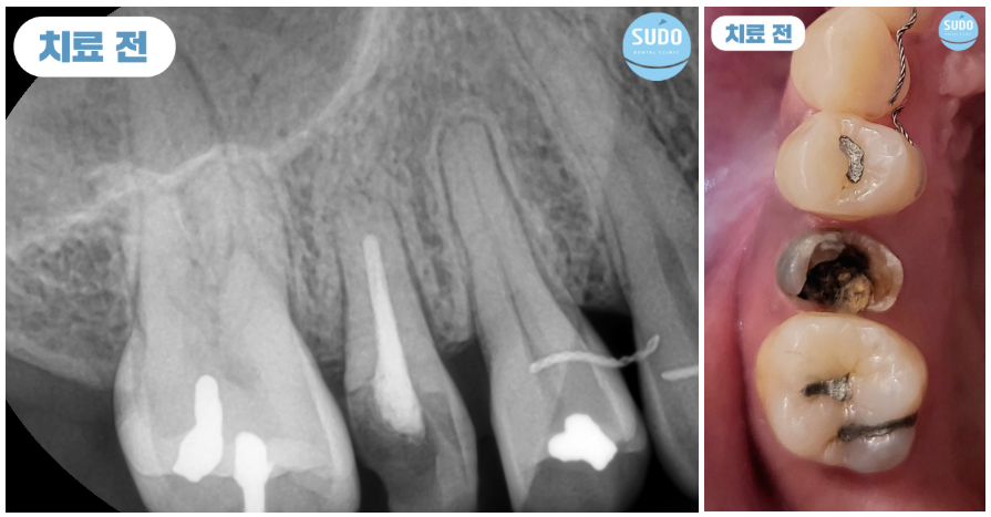 수도치과 임플란트