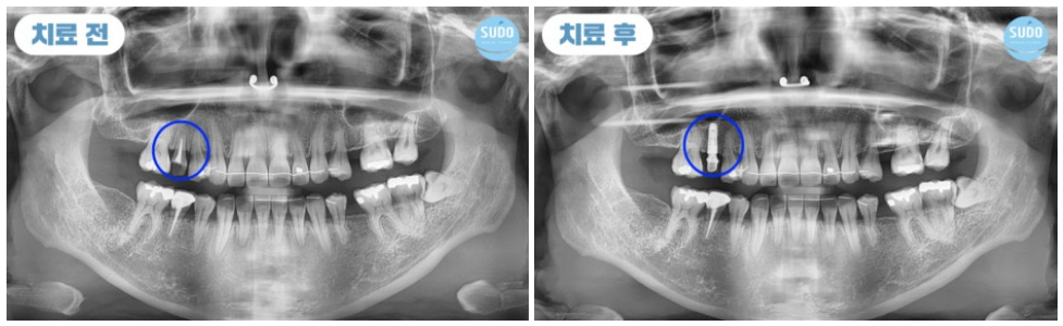 수도치과 임플란트