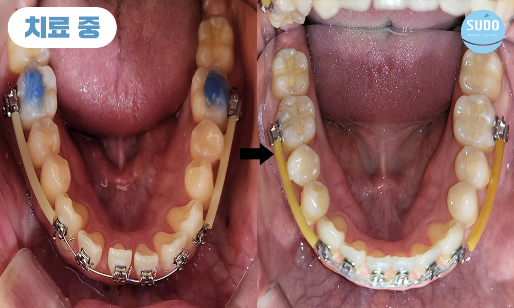 수도치과 치아교정