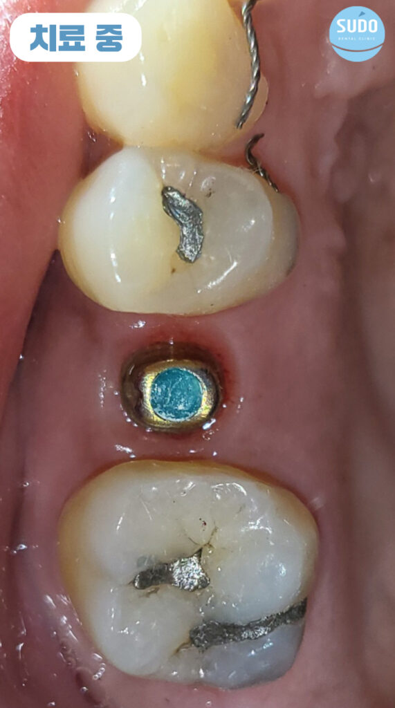 수도치과 임플란트