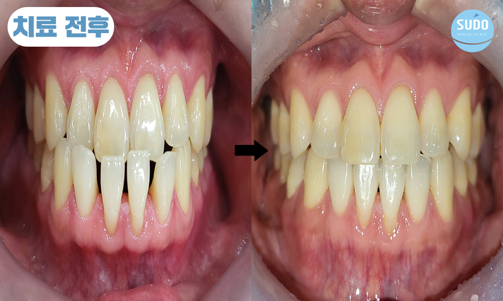 수도치과 치아교정