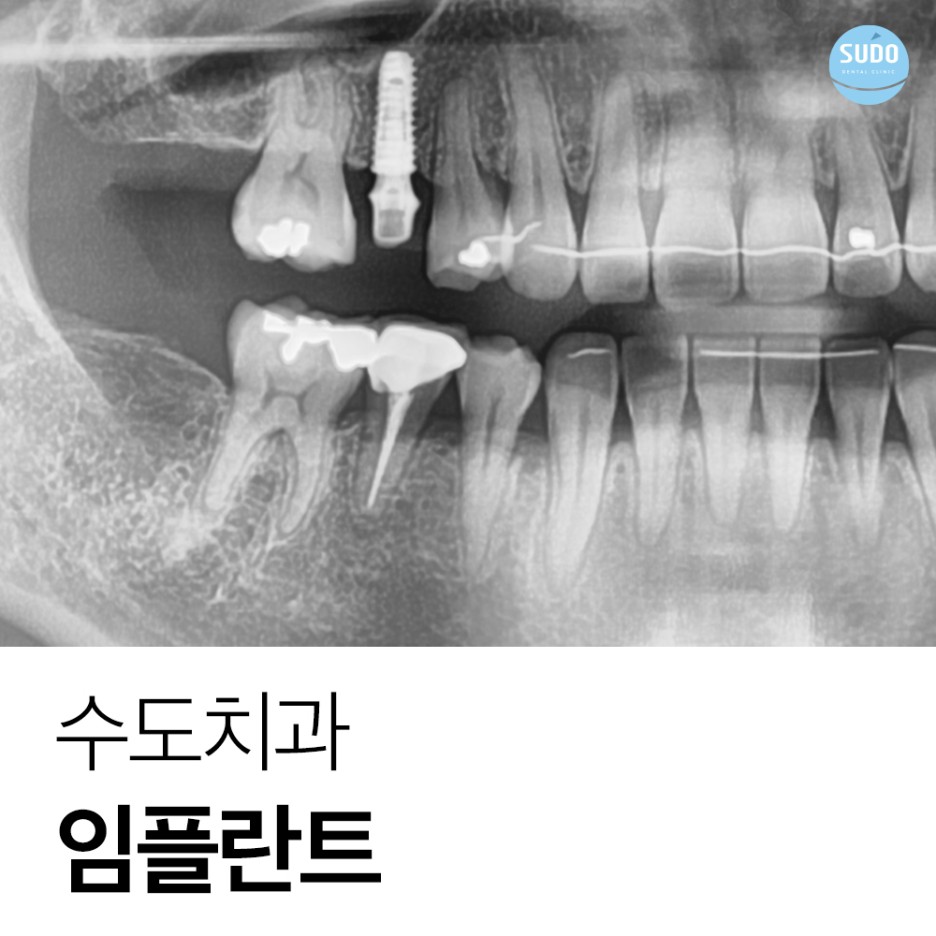 수도치과 임플란트