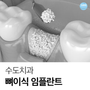 부산영도임플란트