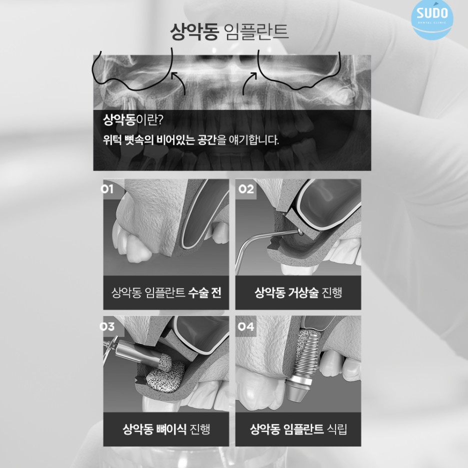 부산영도임플란트