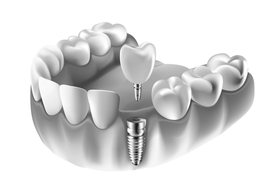보철물과 인공치근을 연결하는 임플란트 나사 구조